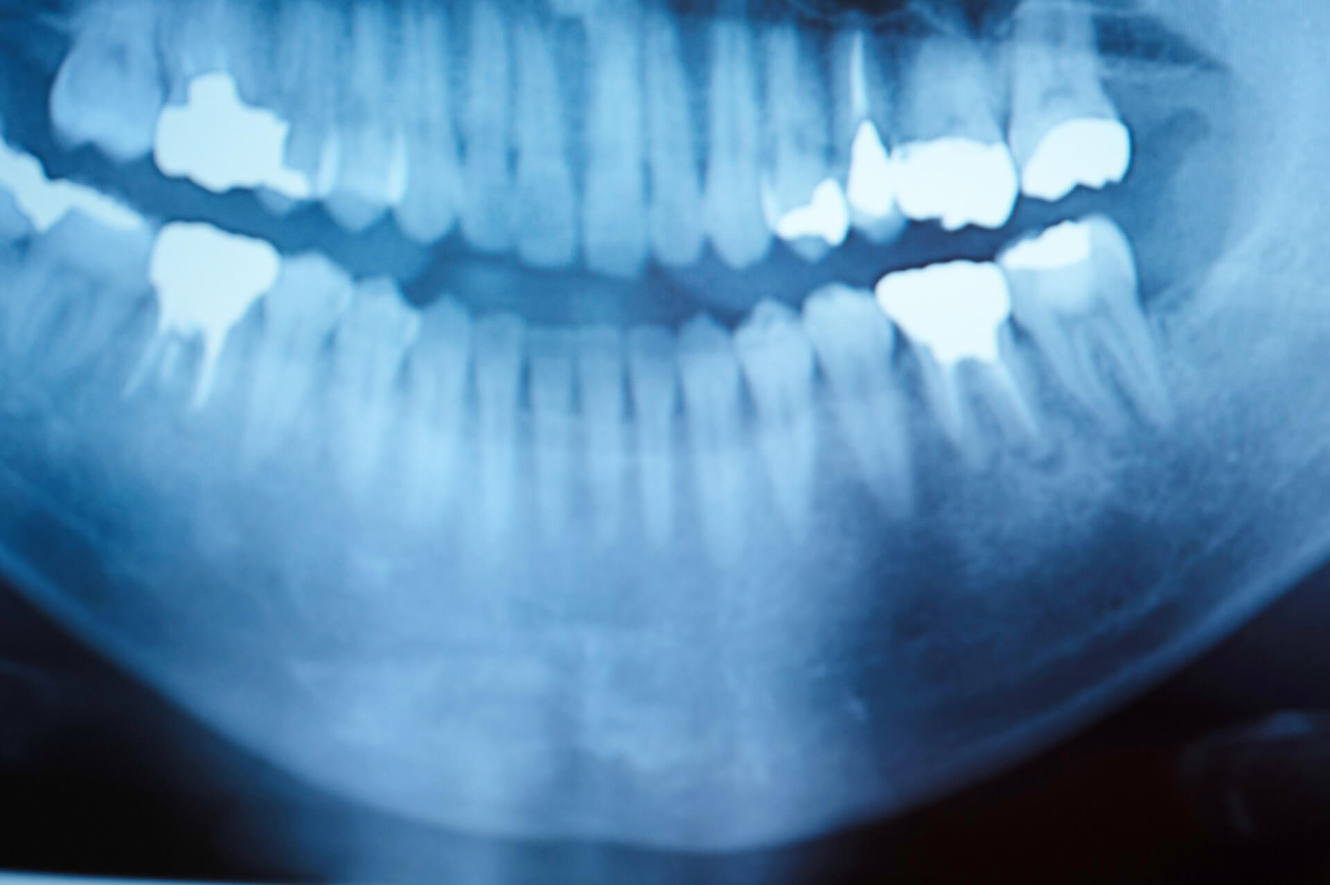 レントゲン撮影